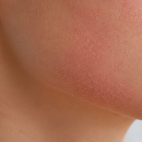 How to Know if Skin Barrier is Damaged