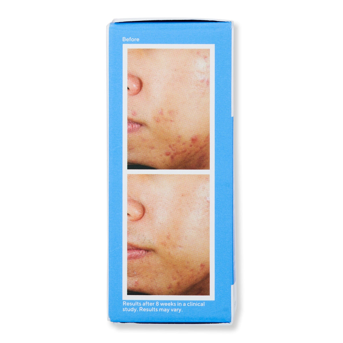 Murad Murad Deep Relief Acne Treatment Acne, Blemish, & Blackhead Treatments 