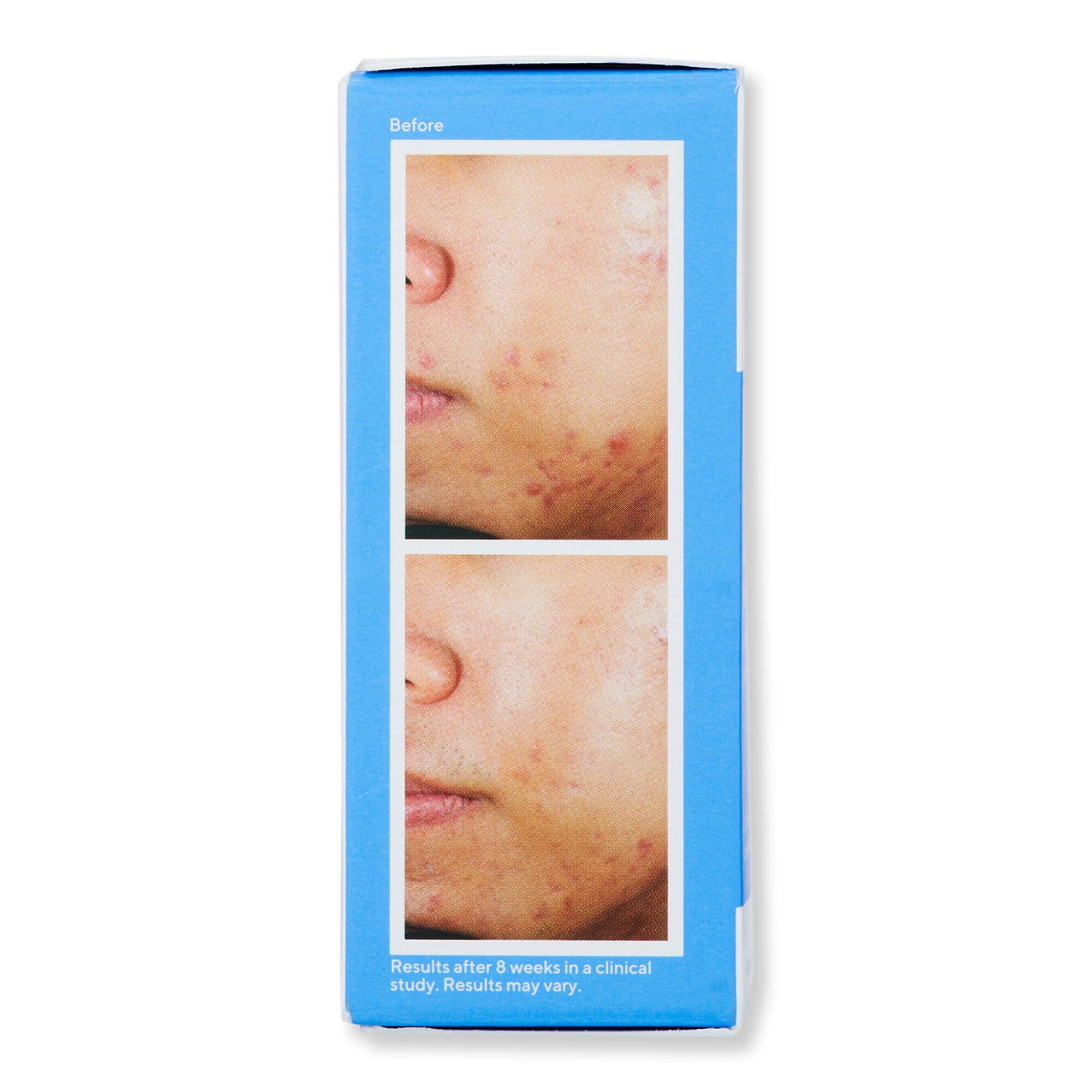 Murad Murad Deep Relief Acne Treatment Acne, Blemish, & Blackhead Treatments 